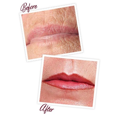 Treatment for Lip Lines