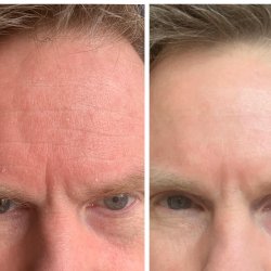 Rynkeplaster til panden og <br />mellem jenbrynene