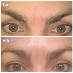 Rynkeplaster til panden og <br />mellem jenbrynene