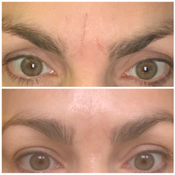 Rynkeplaster til panden og mellem<br /> jenbrynene + Rosewater Ansigtsmist