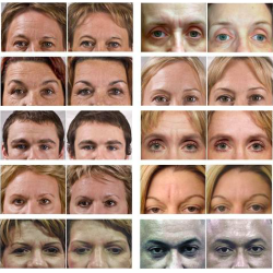 Rynkeplaster til panden og mellem<br /> jenbrynene + Rosewater Ansigtsmist