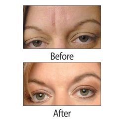 Rynkeplaster til panden og mellem<br /> jenbrynene + Rosewater Ansigtsmist